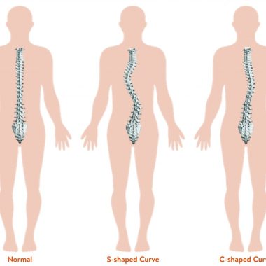 Free Scoliosis Screenings