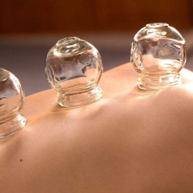 cupping therapy gold coast
