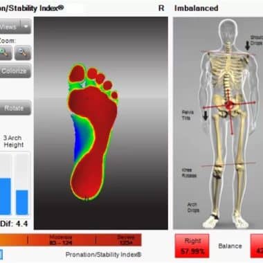 Foot Levelers foot scan report 380x380 - How to know if you need Orthotics?