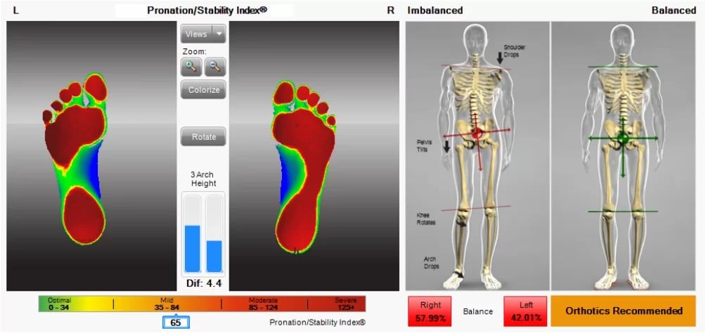 Foot Levelers foot scan report - How to know if you need Orthotics?